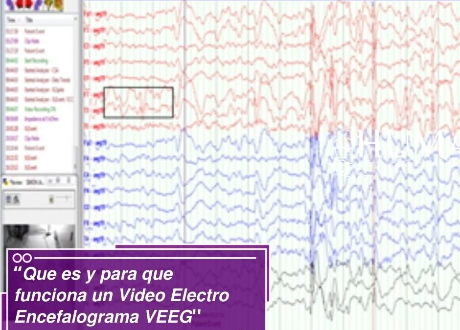 “Que es y para que funciona un Video Electro Encefalograma VEEG”